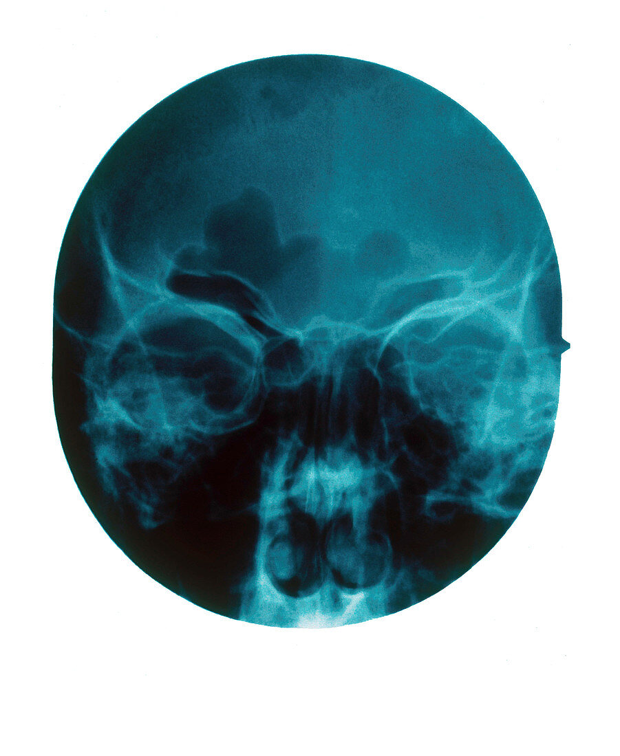 Nasal Polyp,X-ray