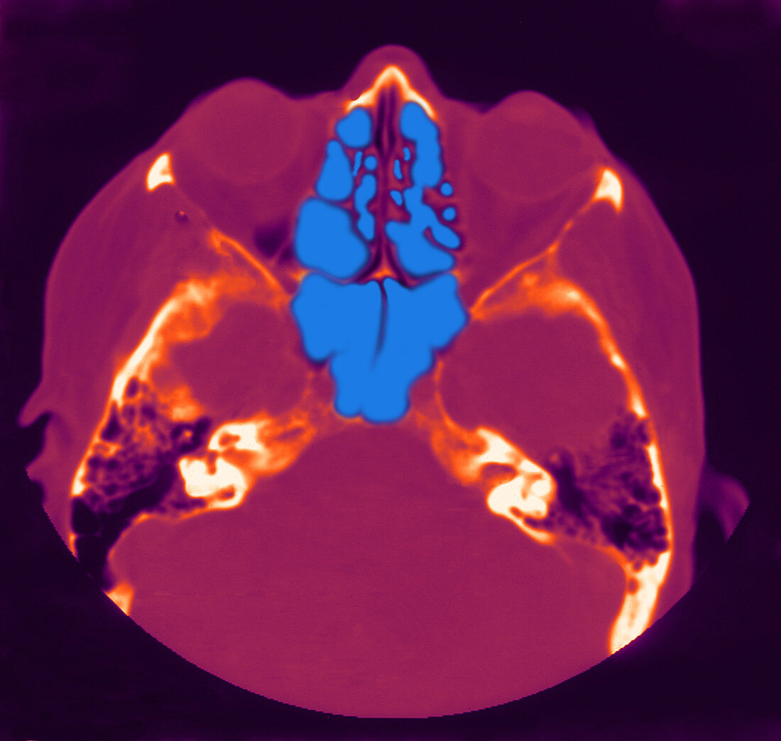 Normal MRI of Sinuses