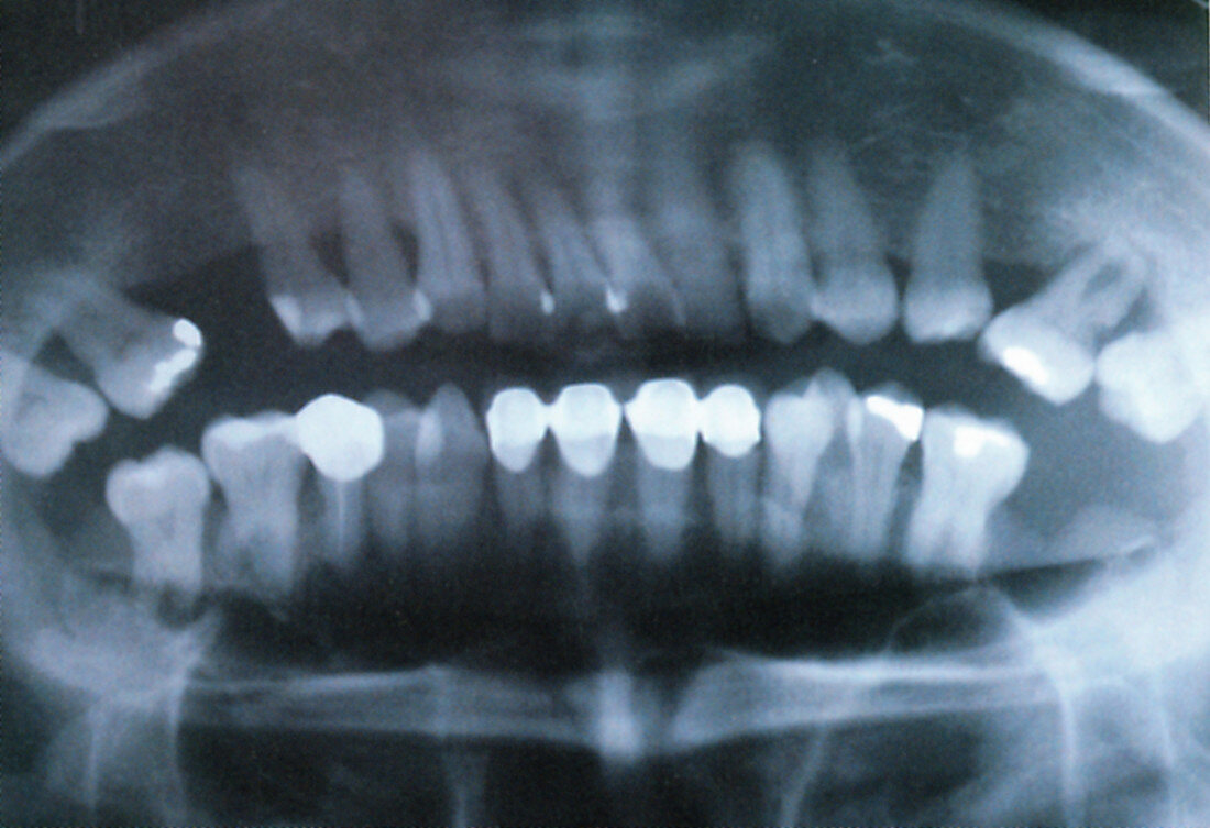 Panoramic Dental X-Ray