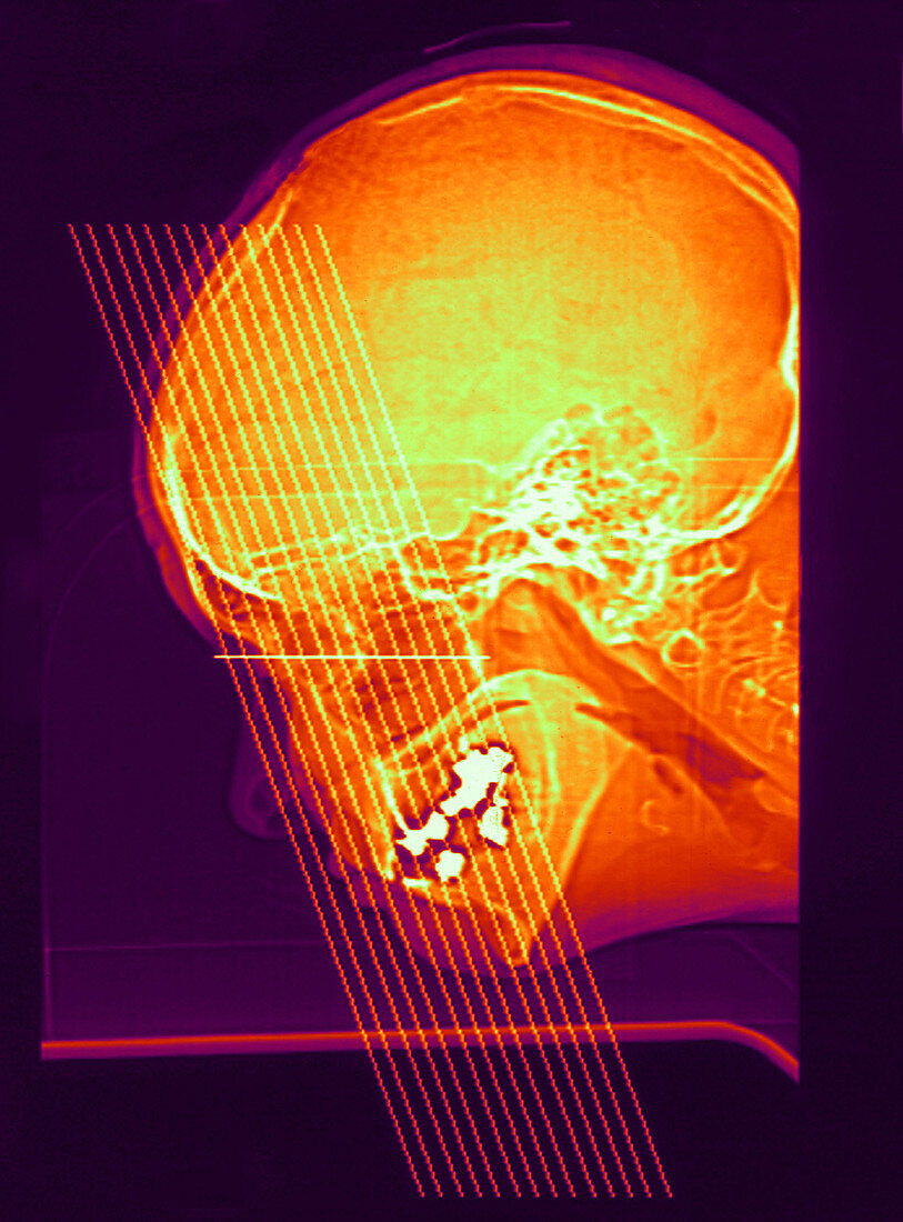 Normal X-ray of Sinuses