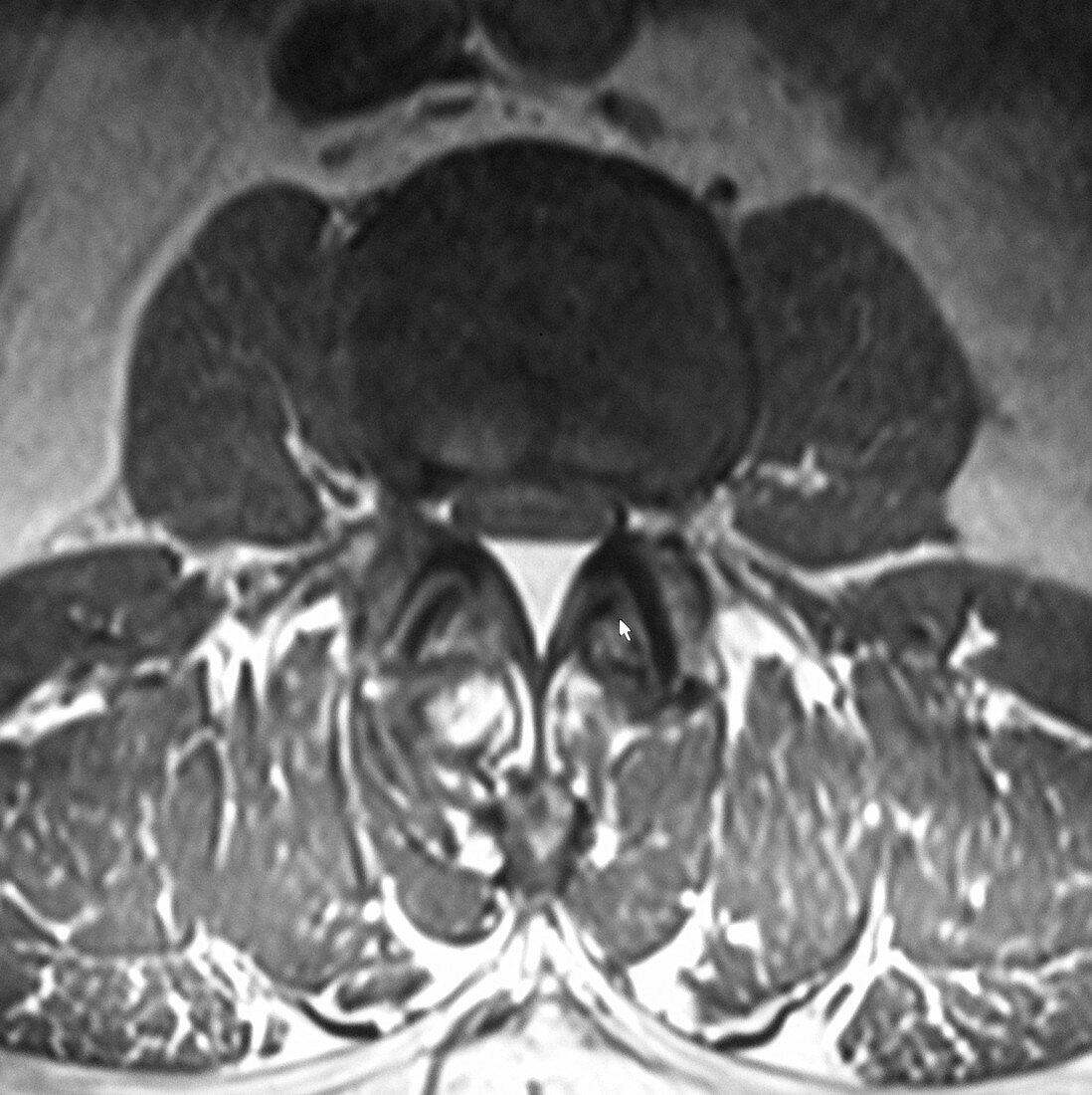 Epidural Lipomatosis,MRI