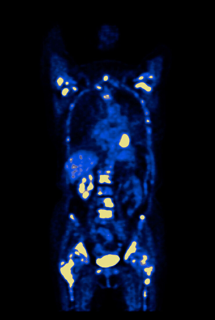 Metastatic Disease (PET Scan)