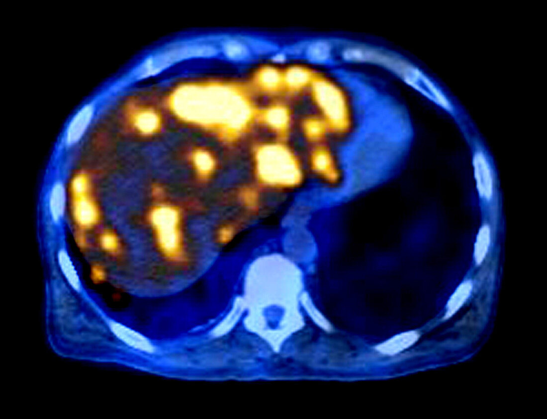 Liver Metastases (PET CT Scan)