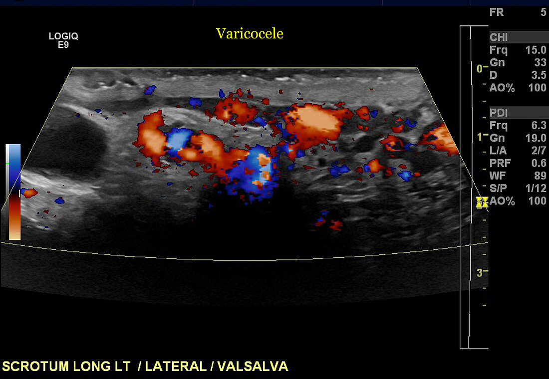 Scrotal Varicocele,Ultrasound Image