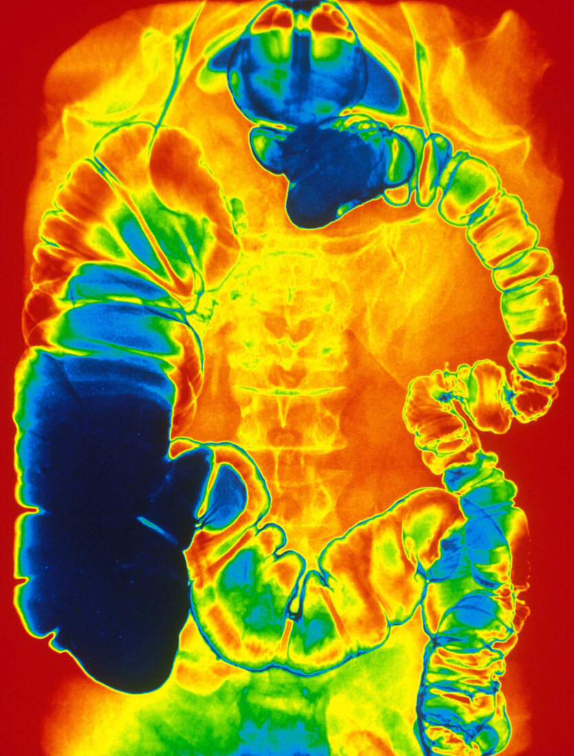 Large and Small Intestine,Barium X-ray