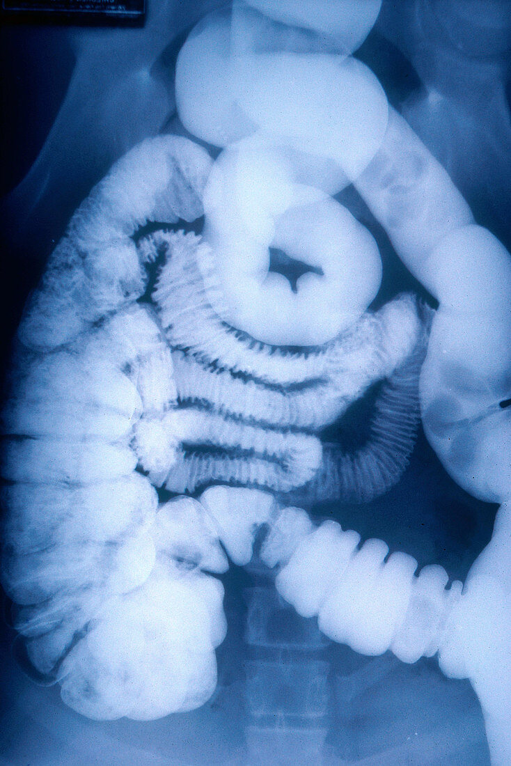 Large and Small Intestine,Barium X-ray