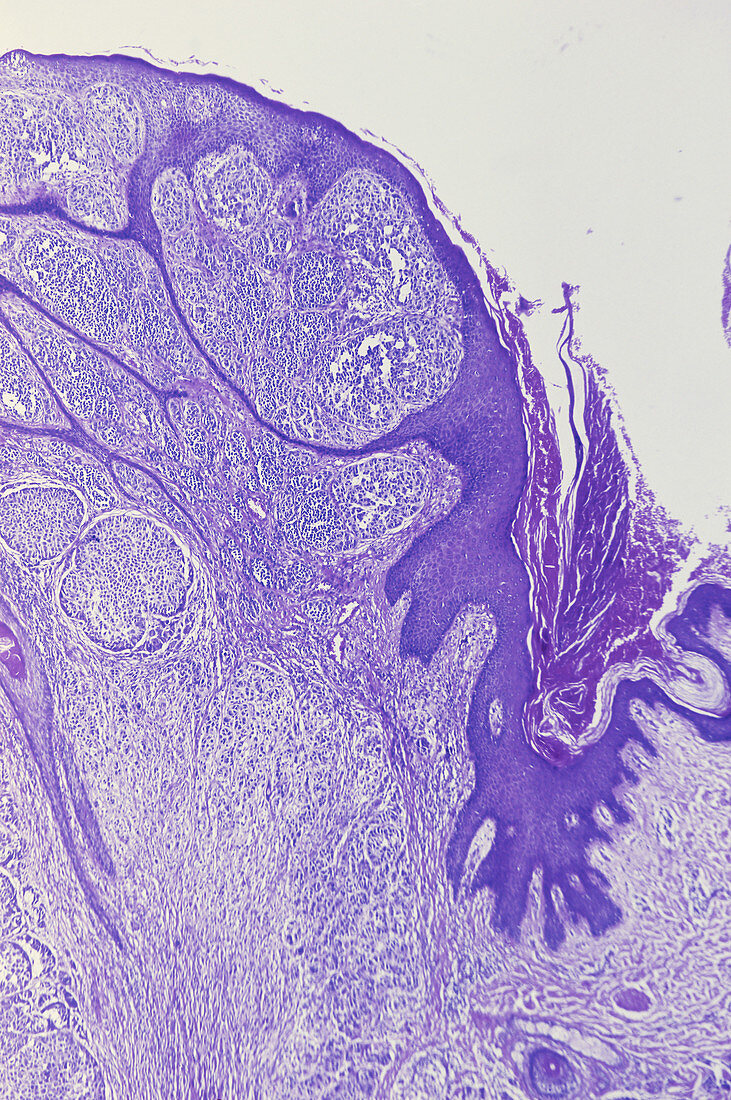 Melanoma,LM