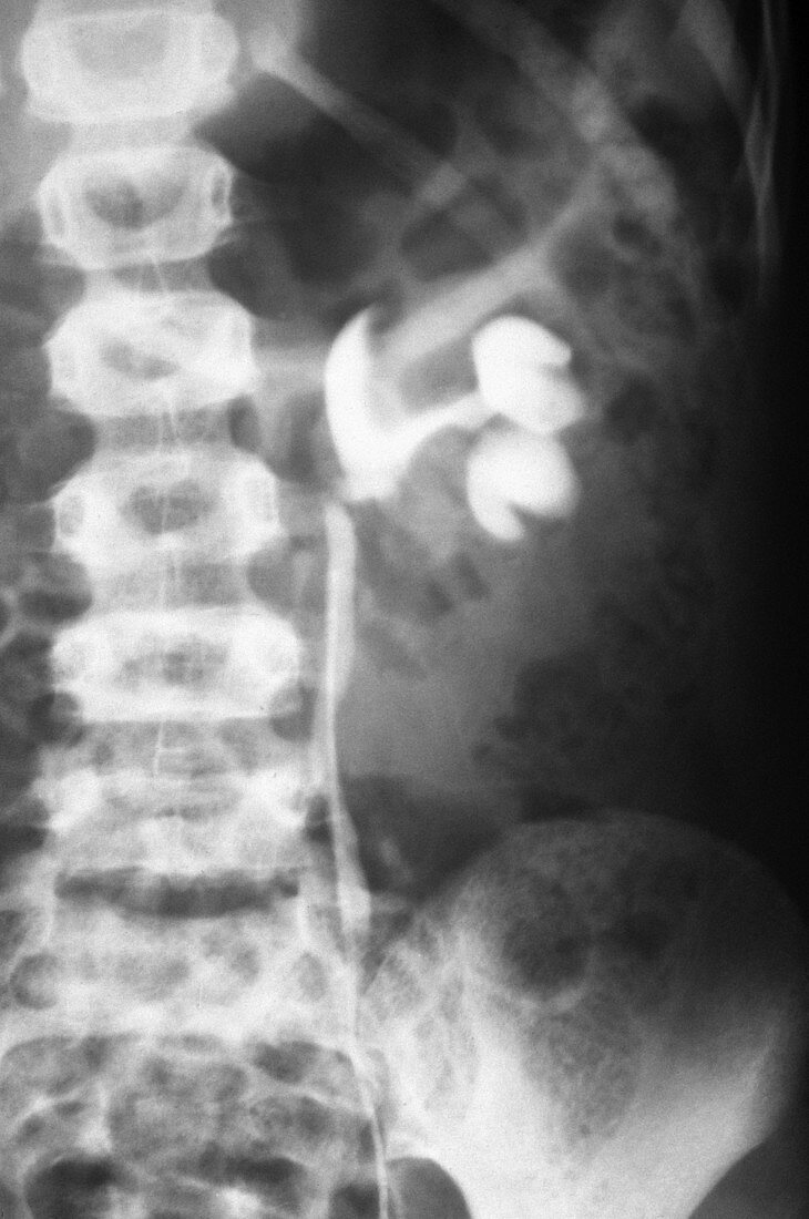 Kidney Tumour,X-ray
