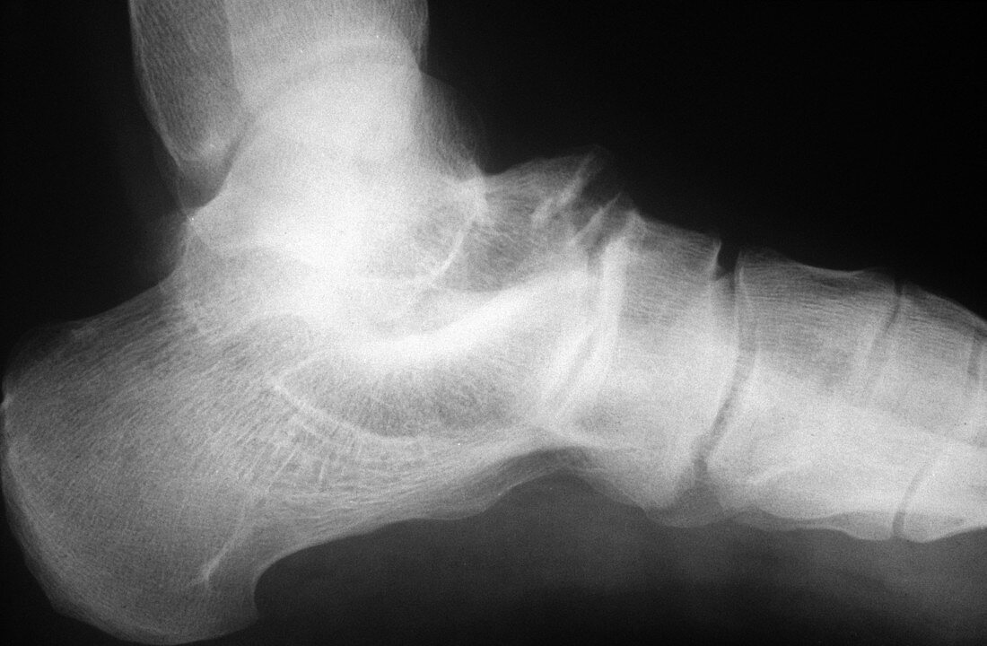 Osteomyelitis,X-ray