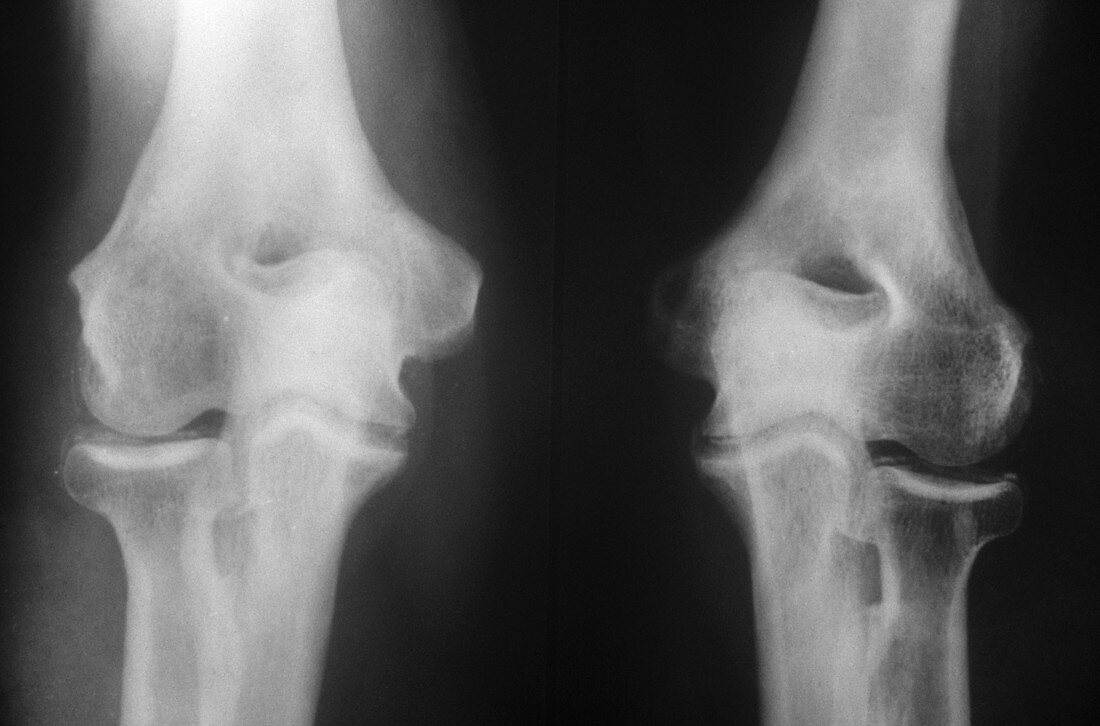 Chondrocalcinosis,X-ray