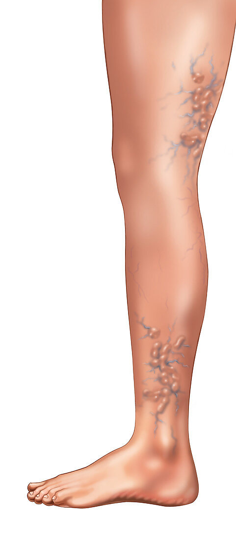 Varicose Veins