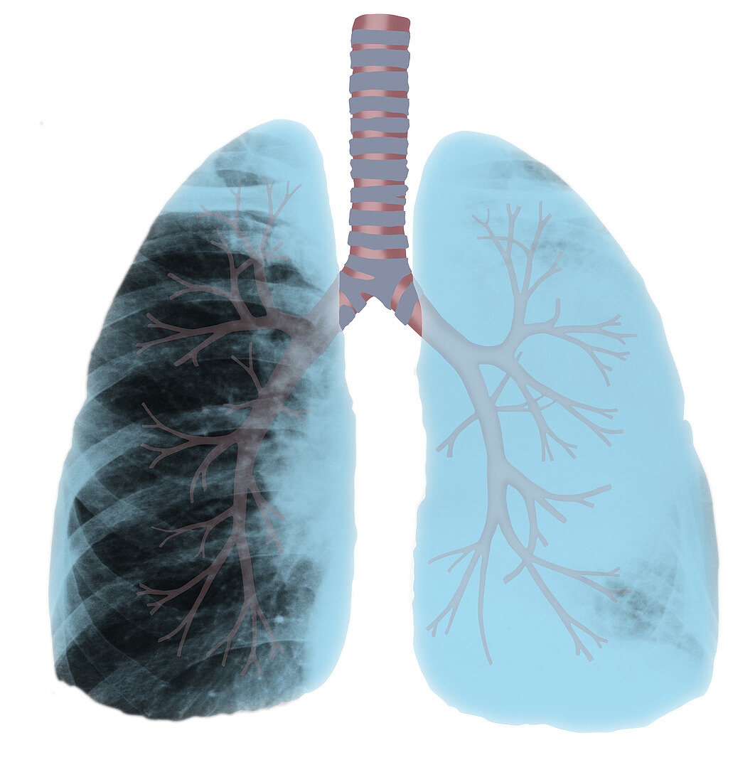 Bronchus Cancer