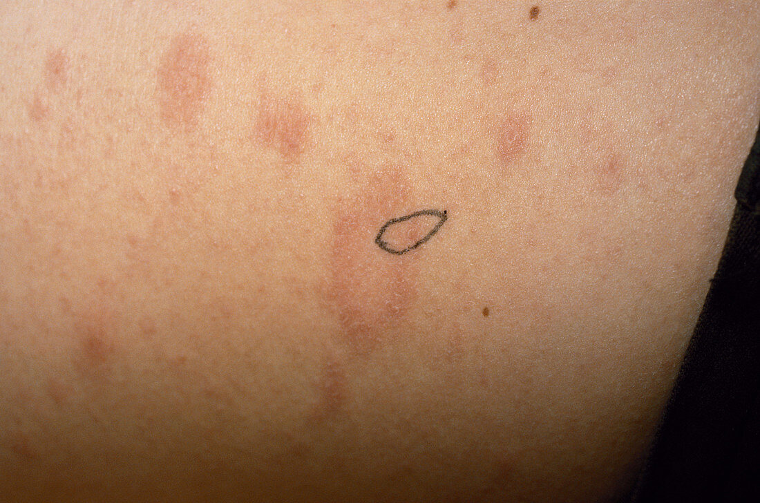 Skin Biopsy Marker