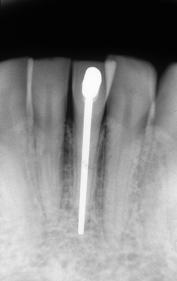 Root Canal Filling,X-ray