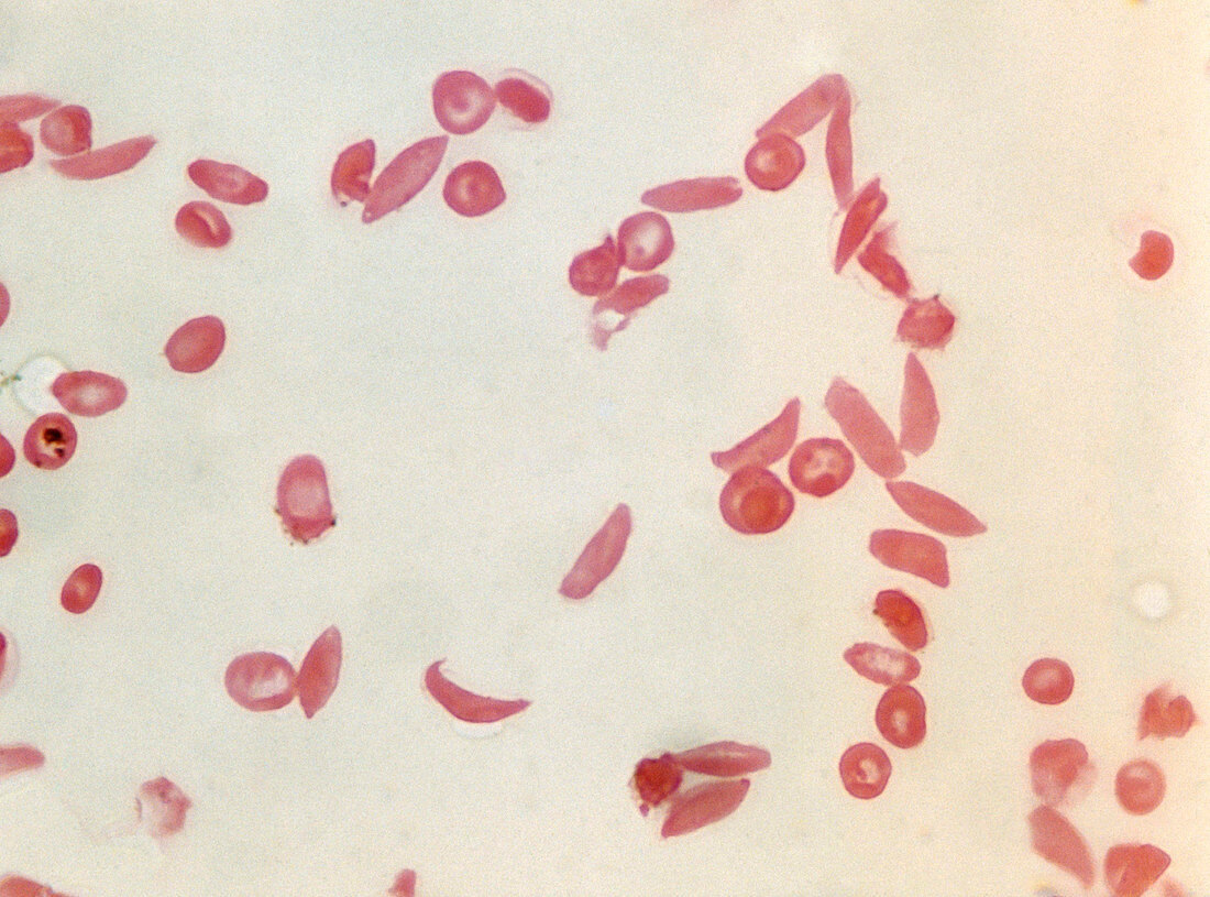 Sickle cell anaemia,light micrograph