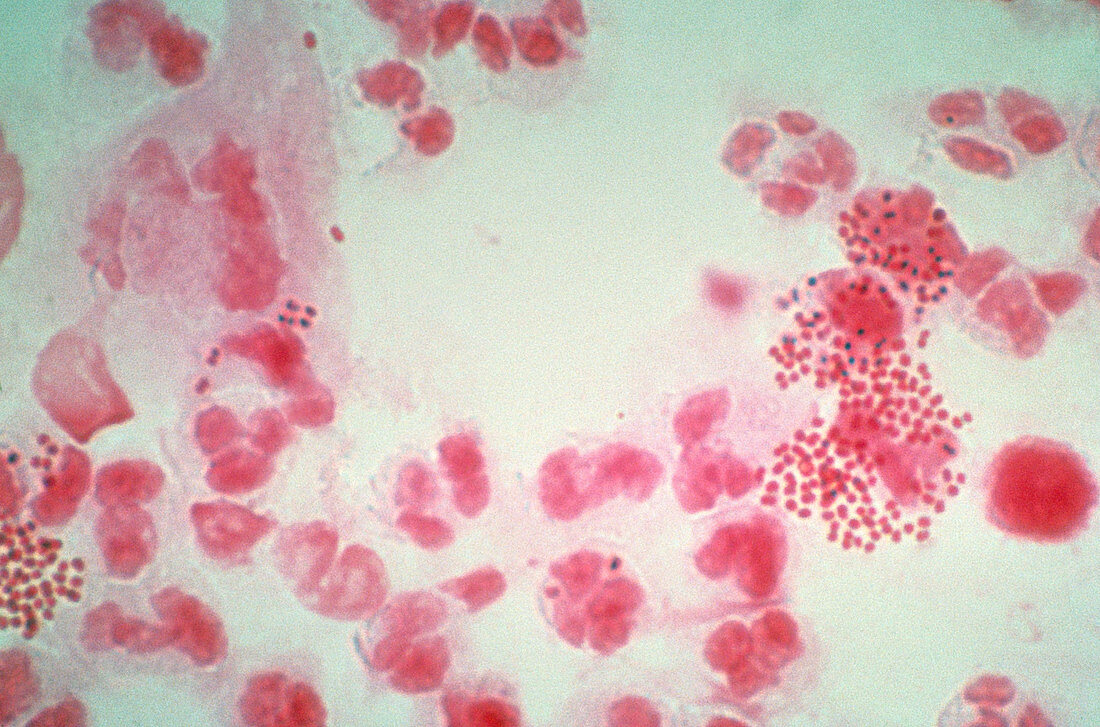 Gonorrhoea infection,light micrograph