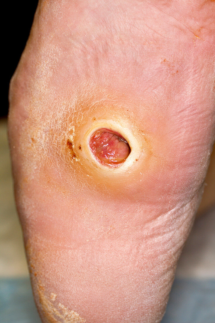 Diabetic foot