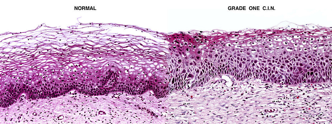 Cervical Intraepithelial Neoplasia (CIN)