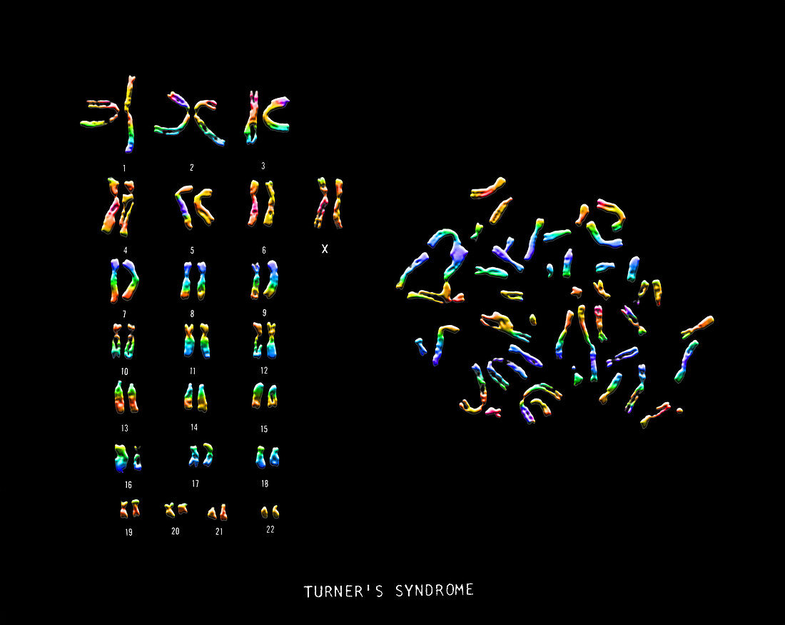 Turner's Syndrome Karyotype