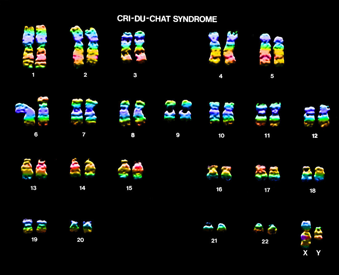 Cri-Du-Chat Syndrome