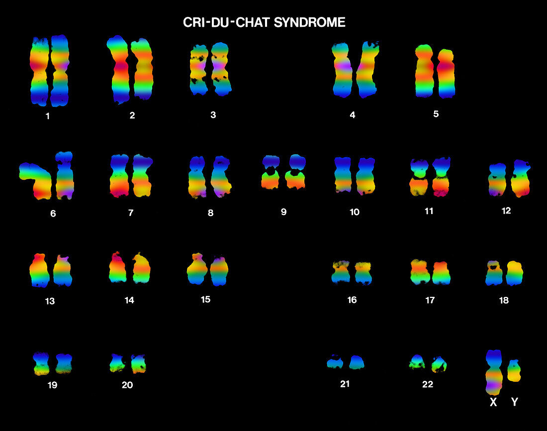 Cri du chat syndrome karyotype