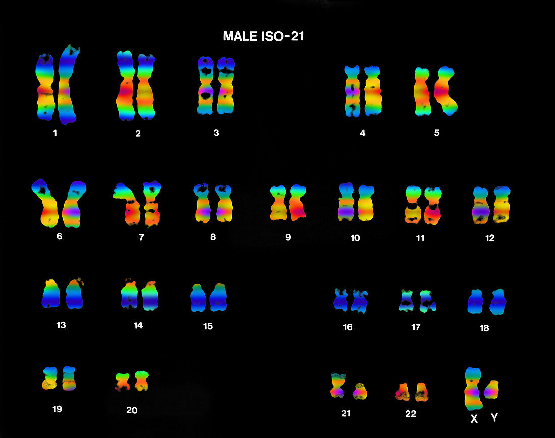 Isochromosome 21 in Male Karyotype