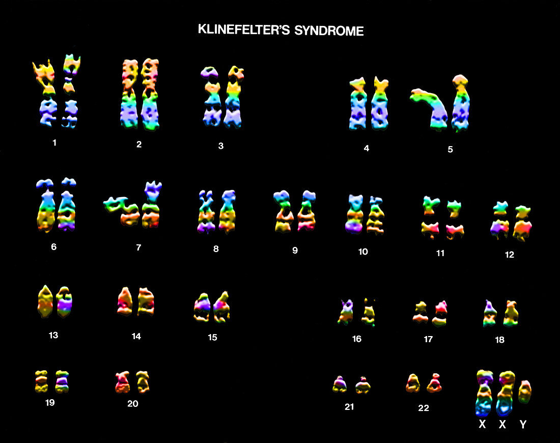 Klinefelter S Syndrome Karyotype Bild Kaufen 12030804 Science Photo Library
