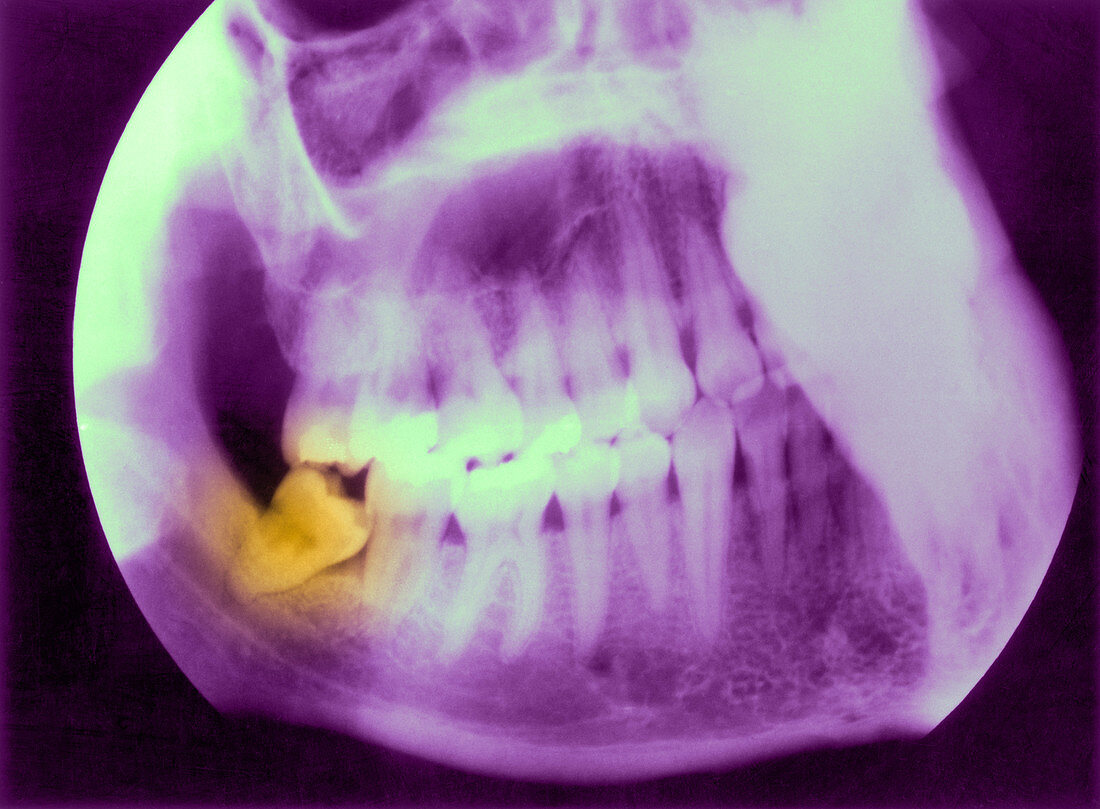 Impacted Wisdom Tooth