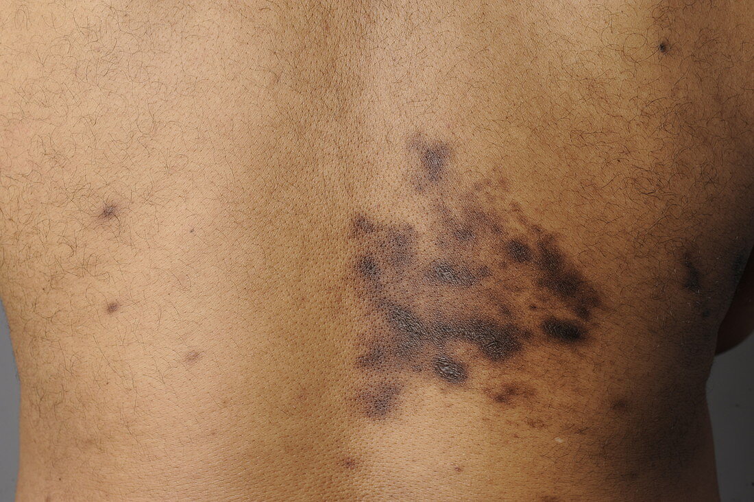Man with Scarring from Shingles,28 Weeks