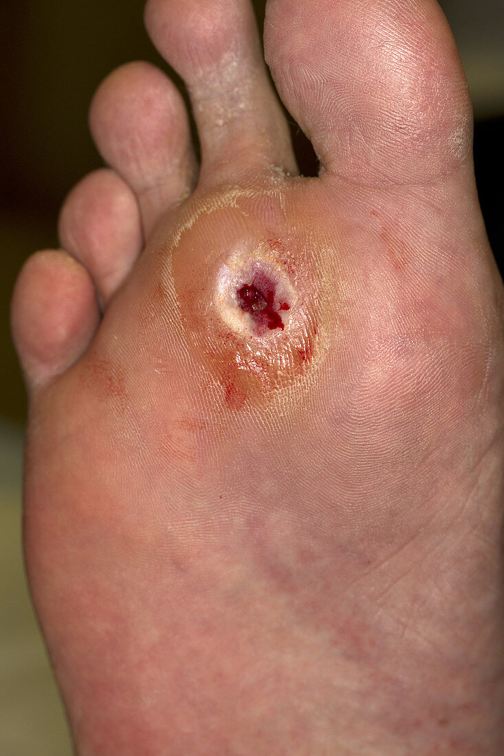 Diabetic Ulcer on Foot