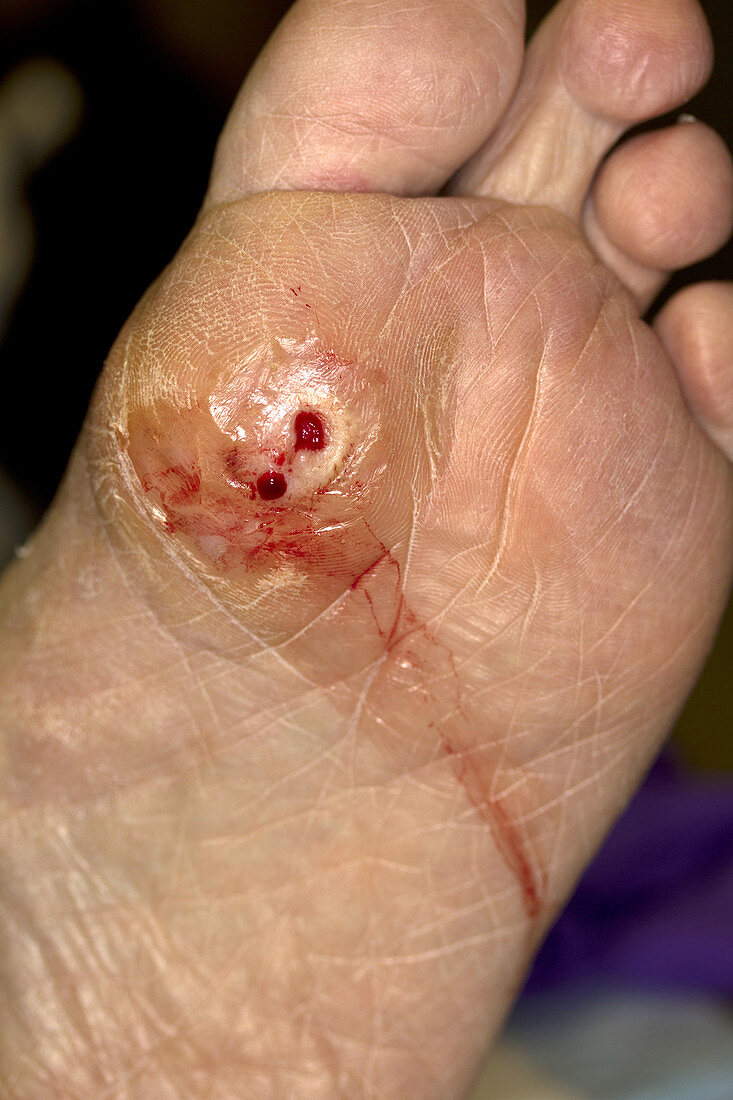 Diabetic Ulcer on Foot