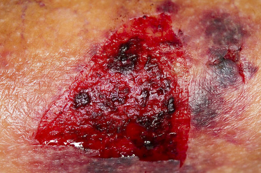 Traumatic leg wound