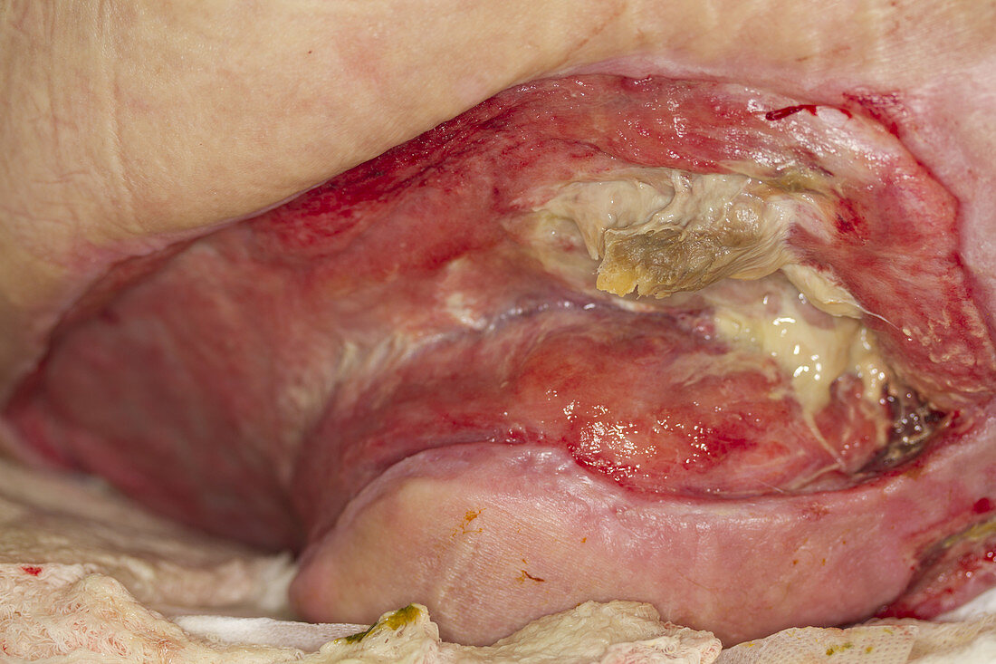 Sacral Pressure Ulcer Stage IV