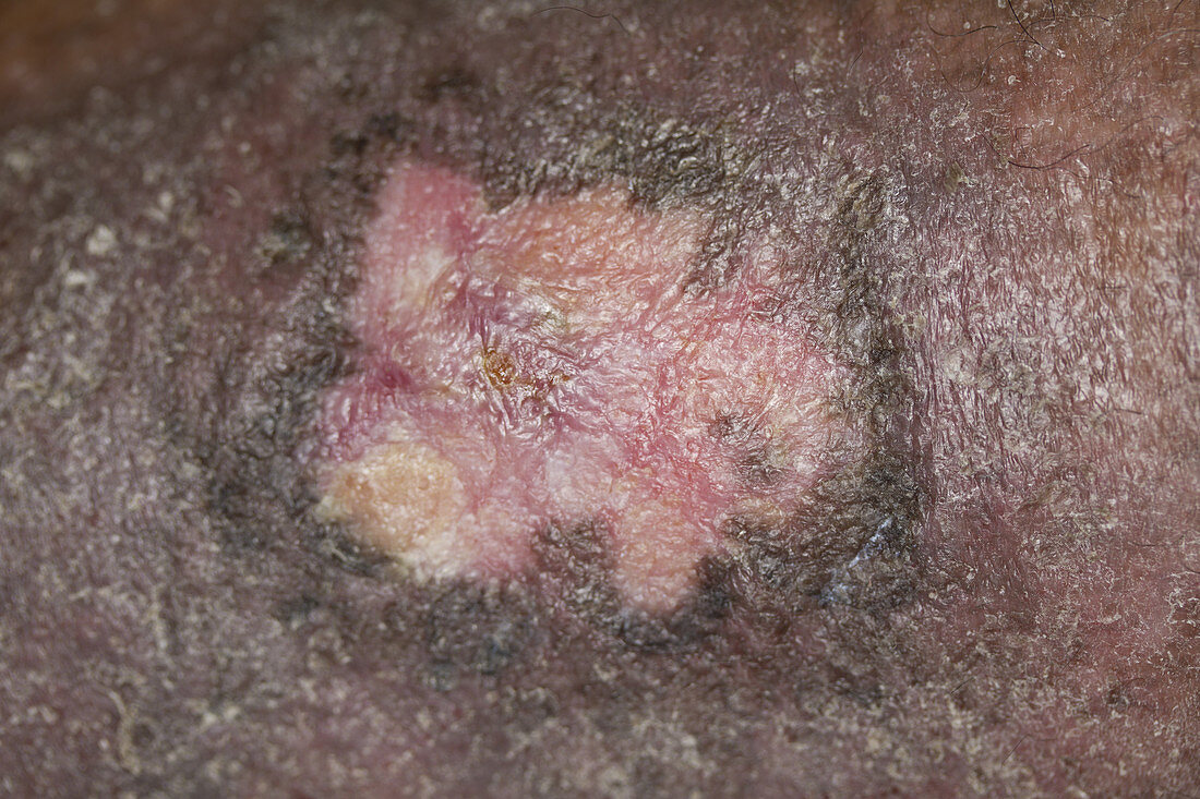 Healed CVI Wound