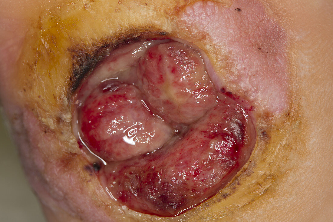 Foot Pressure Ulcer Stage III