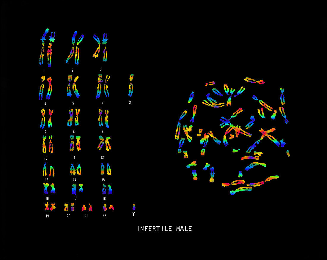 Infertile Male Karyotype