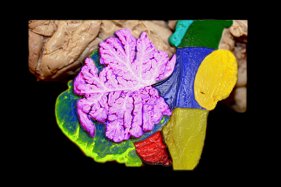 Brainstem,Cerebellum and Occipital Lobe