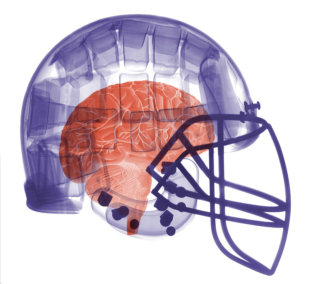 X-ray of Head in Football Helmet