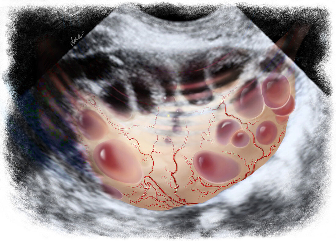 Polycystic Ovary and Ultrasound