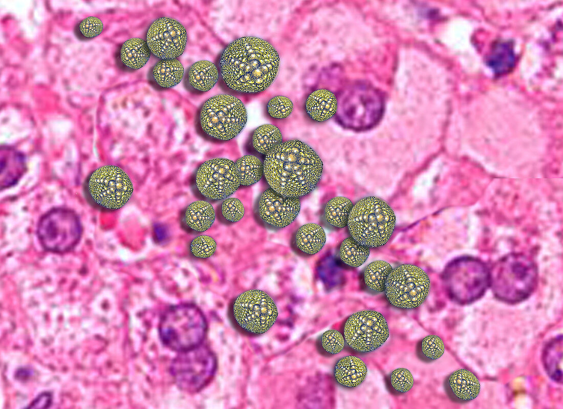 Hepatitis A Infecting Liver Tissue