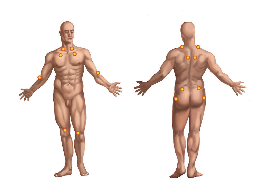 Trigger Points on the Nude Man
