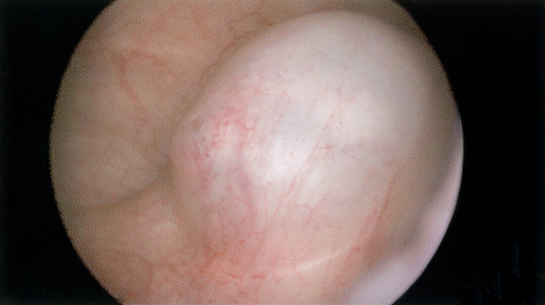 Ureterocele,Left Ureter
