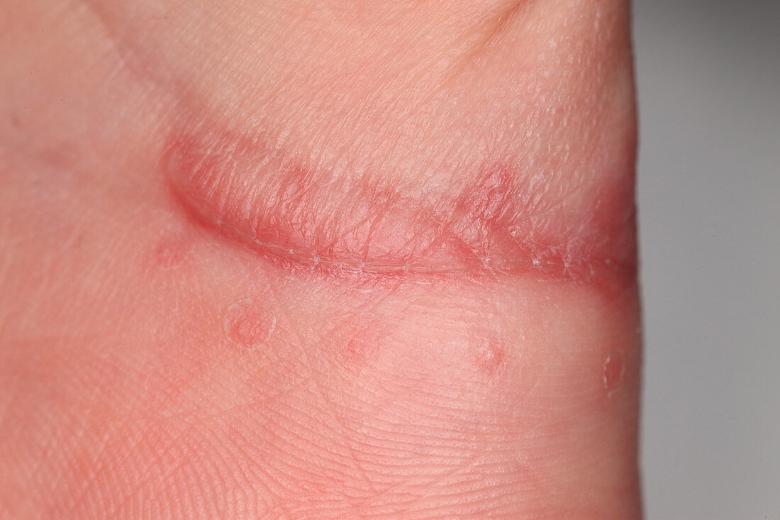 Wound Healing (Day 28)