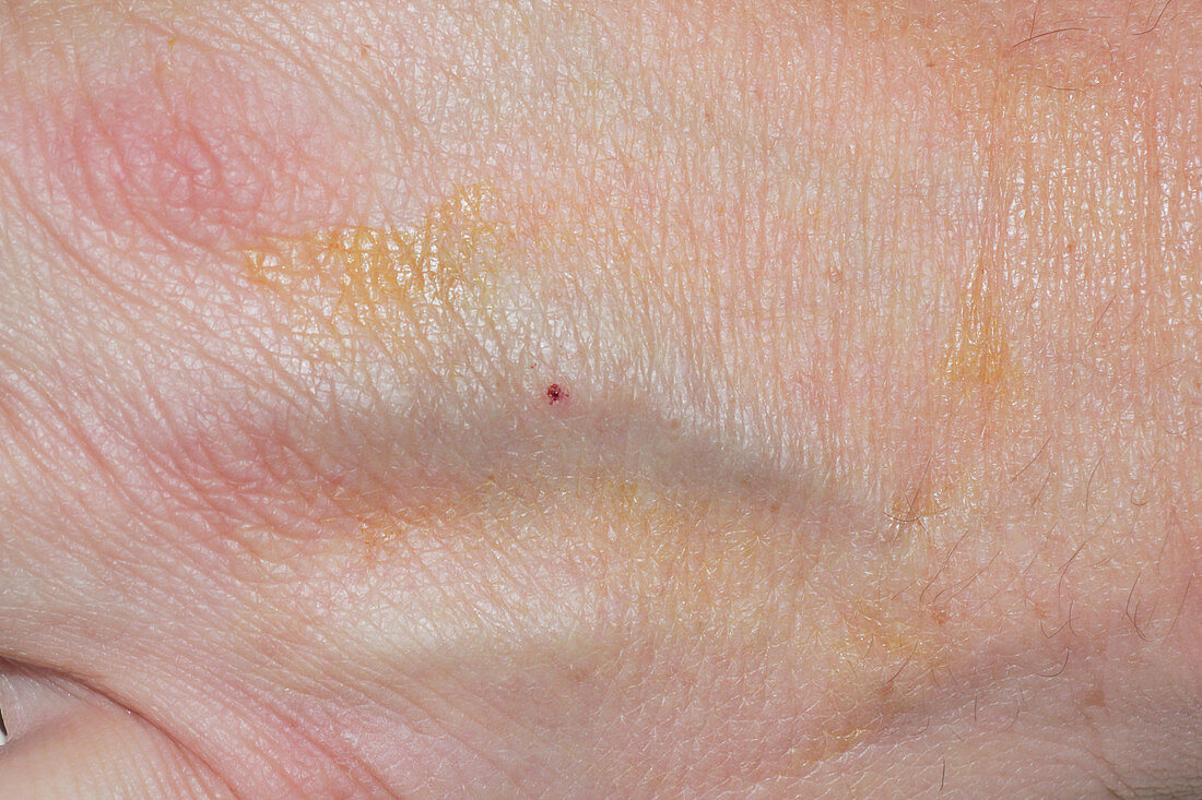 IV Site on Hand