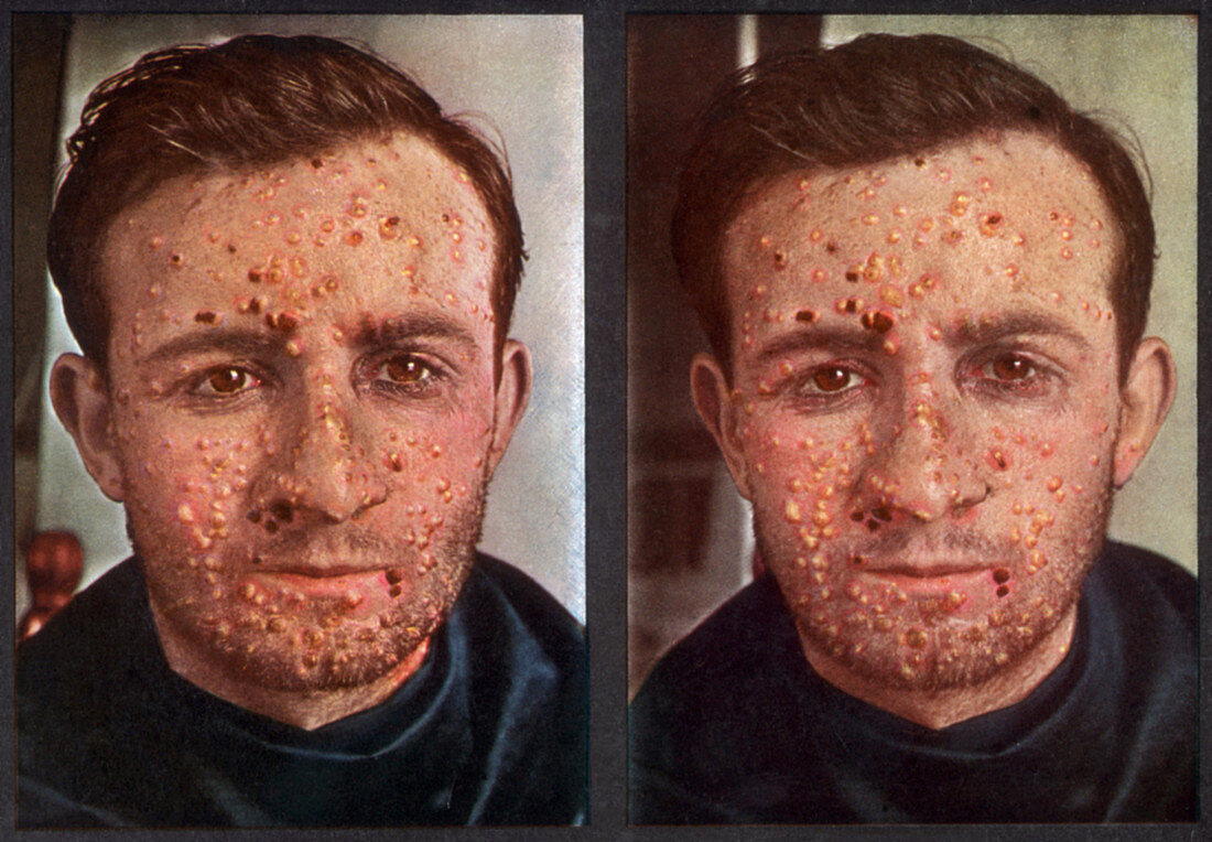 Smallpox,Vintage Stereoscopic Image