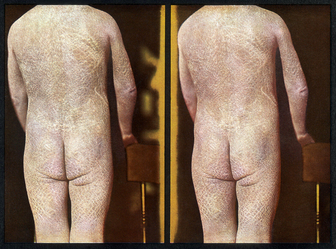 Ichthyosis,Vintage Stereoscopic Image