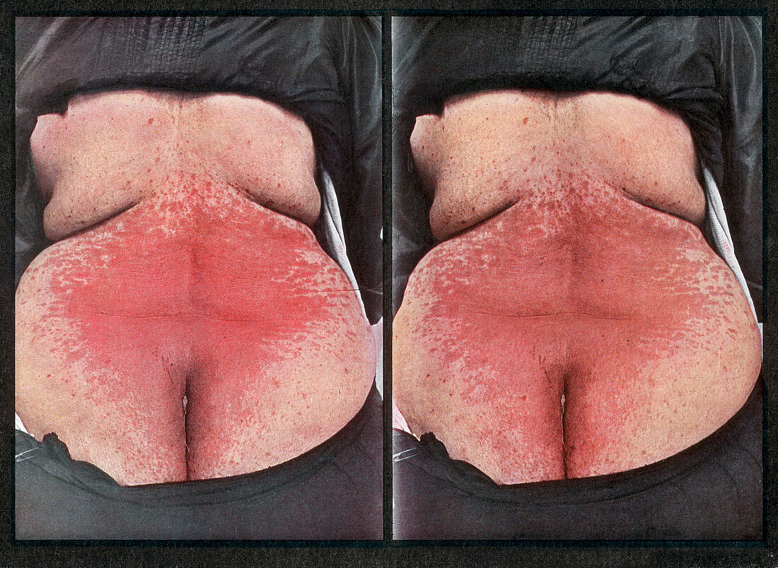 Eczema rubrum,Vintage Stereoscopic Image