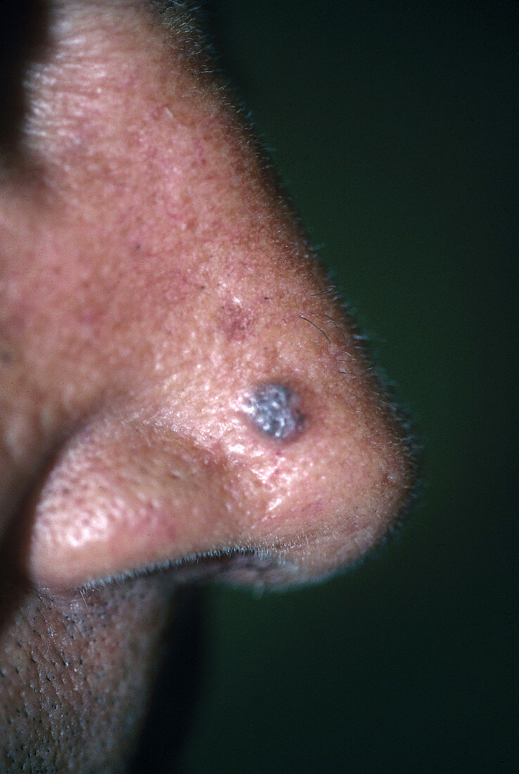Basal Cell Carcinoma on Nose