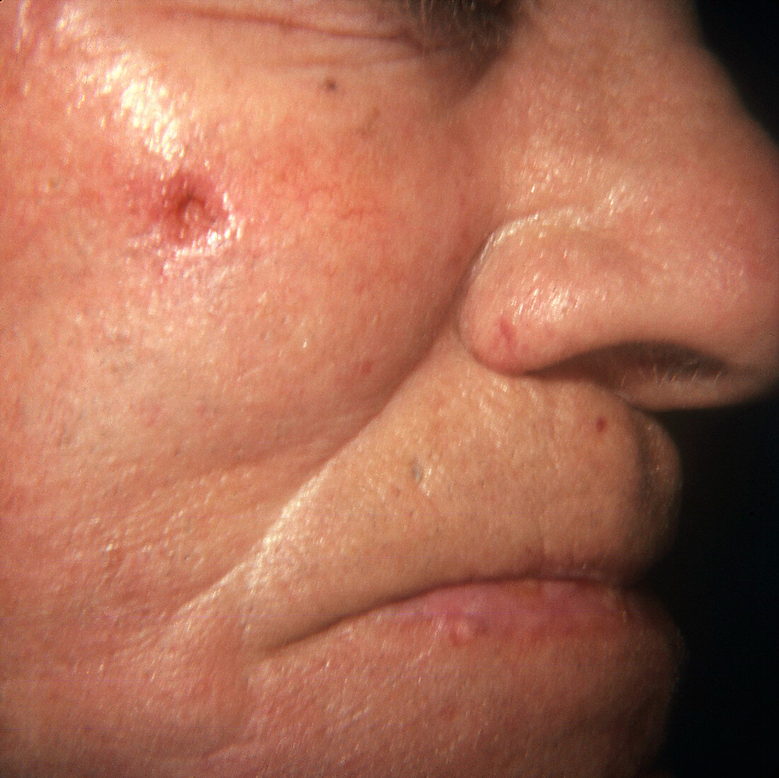 Rodent Ulcer on Patient's Cheek
