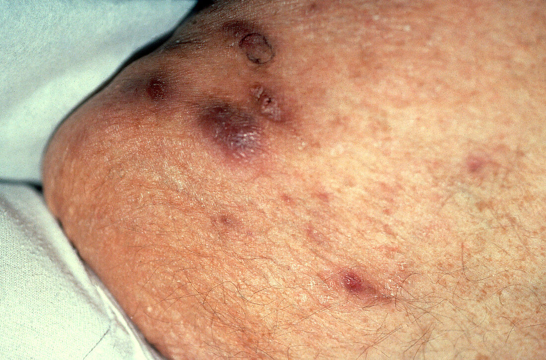 Boils on Patient's Thigh